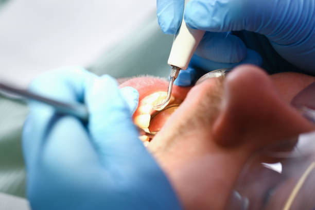 Best Emergency Tooth Extraction in White Salmon, WA